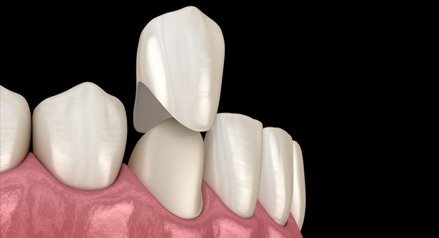 Dental crown placement on tooth model showing white ceramic restoration on pink gum base against black background.