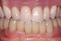 Close-up view of natural, healthy upper and lower teeth showing proper dental alignment and oral health.