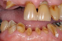 Close-up of dental work showing two upper front teeth with crown restoration and surrounding natural teeth