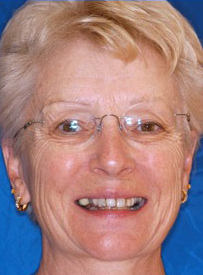 Woman smiling at camera wearing glasses against blue background, dental care portrait.