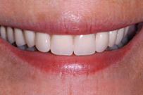 Close-up of a person's smile displaying bright, white, evenly-spaced teeth and healthy gums.