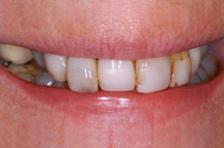 Close-up of patient's smile showing dental veneers and tooth restoration work.
