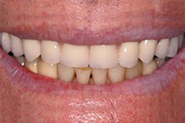 Close-up of patient's smile showing upper and lower teeth with dental work or treatment results.