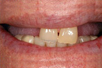 Close-up of patient's smile showing dental bridge restoration with multiple artificial teeth in upper jaw.