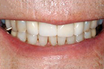 Close-up of a person's smile showing natural teeth and gums in dental care context.