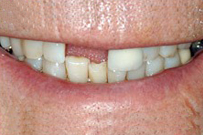 Close-up of patient's smile showing upper and lower teeth with visible gaps and discoloration before dental treatment.