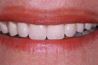 Close-up of bright white teeth showing a healthy smile against pink lips and skin.