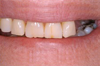 Close-up of human smile showing front teeth with visible dental work and discoloration.