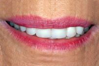 Close-up of smiling teeth showing bright white smile with pink lipstick application