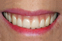 Close-up of a person's smile showing teeth and pink lips in a dental care context.