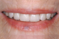 Close-up of a person's smile showing white teeth and natural lips in dental care context.