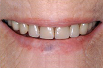 Close-up of adult's smile showing upper front teeth with visible gaps and discoloration.