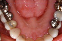 Close-up intraoral view of upper front teeth and gums during dental examination.