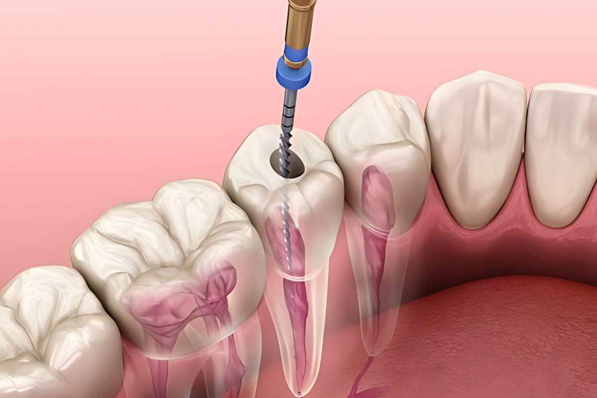 How to care for your tooth after a root canal procedure