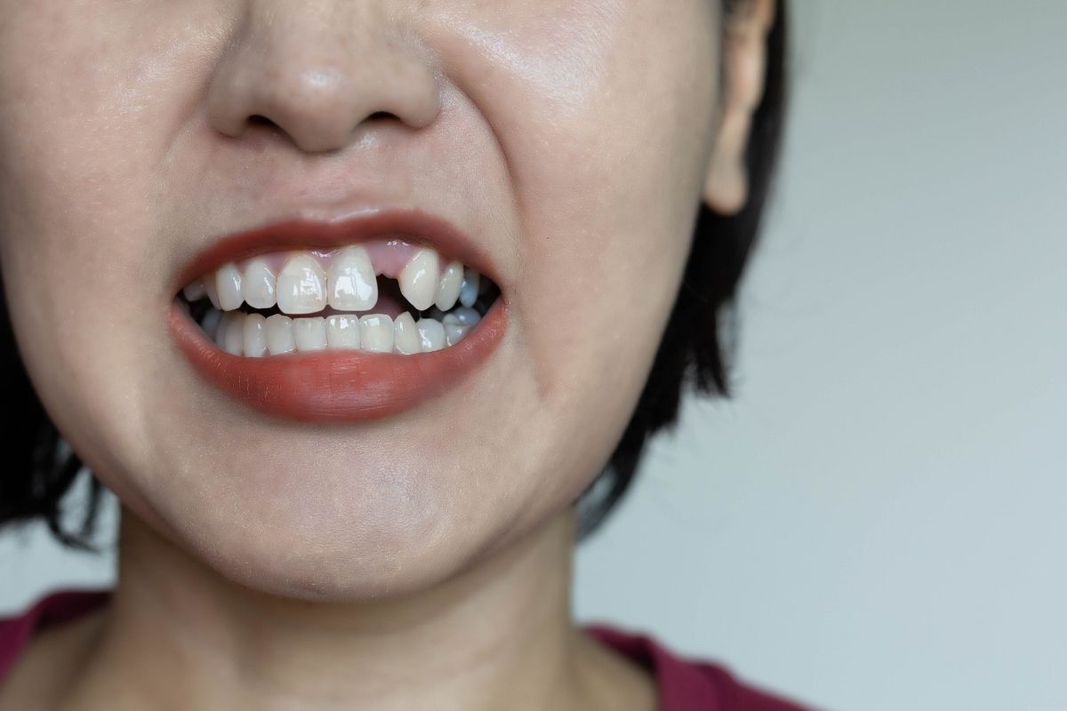 Dental Implants: A Life-Changing Solution for Missing Teeth