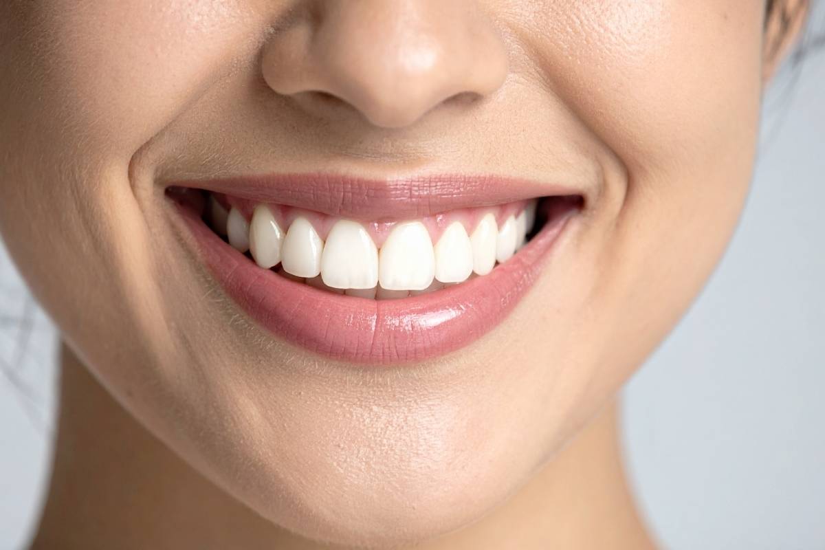 Even tooth color achieved after cosmetic dentistry for white spots