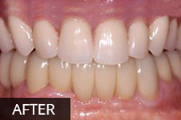 After dental treatment showing brightened, aligned front teeth in healthy smile