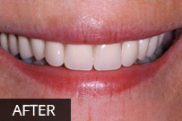After dental treatment showing brightened, evenly aligned teeth in a confident smile.