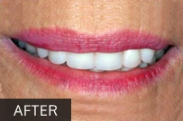 Close-up of smiling lips showing bright white teeth after dental treatment at Sunridge Dental Care.