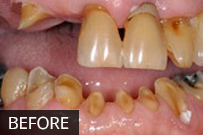 Before dental treatment showing damaged and discolored teeth requiring restoration.