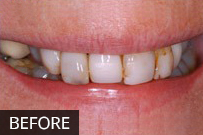 Before dental treatment: close-up of discolored, uneven front teeth showing cosmetic dental issues.