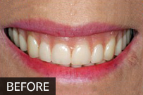 Before dental treatment: closeup of smile showing yellowed teeth and uneven gum line.