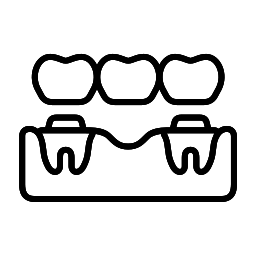 Dental bridge diagram showing three artificial teeth anchored to adjacent teeth for tooth replacement.