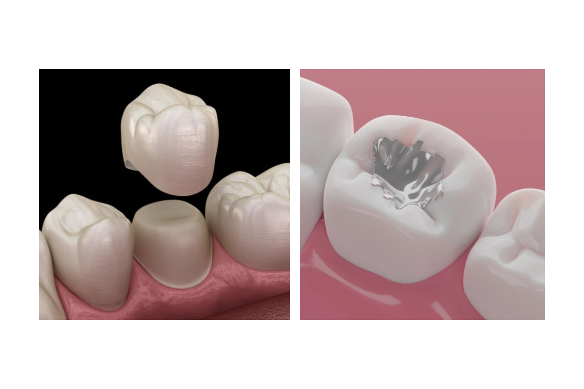 dental crown vs filling